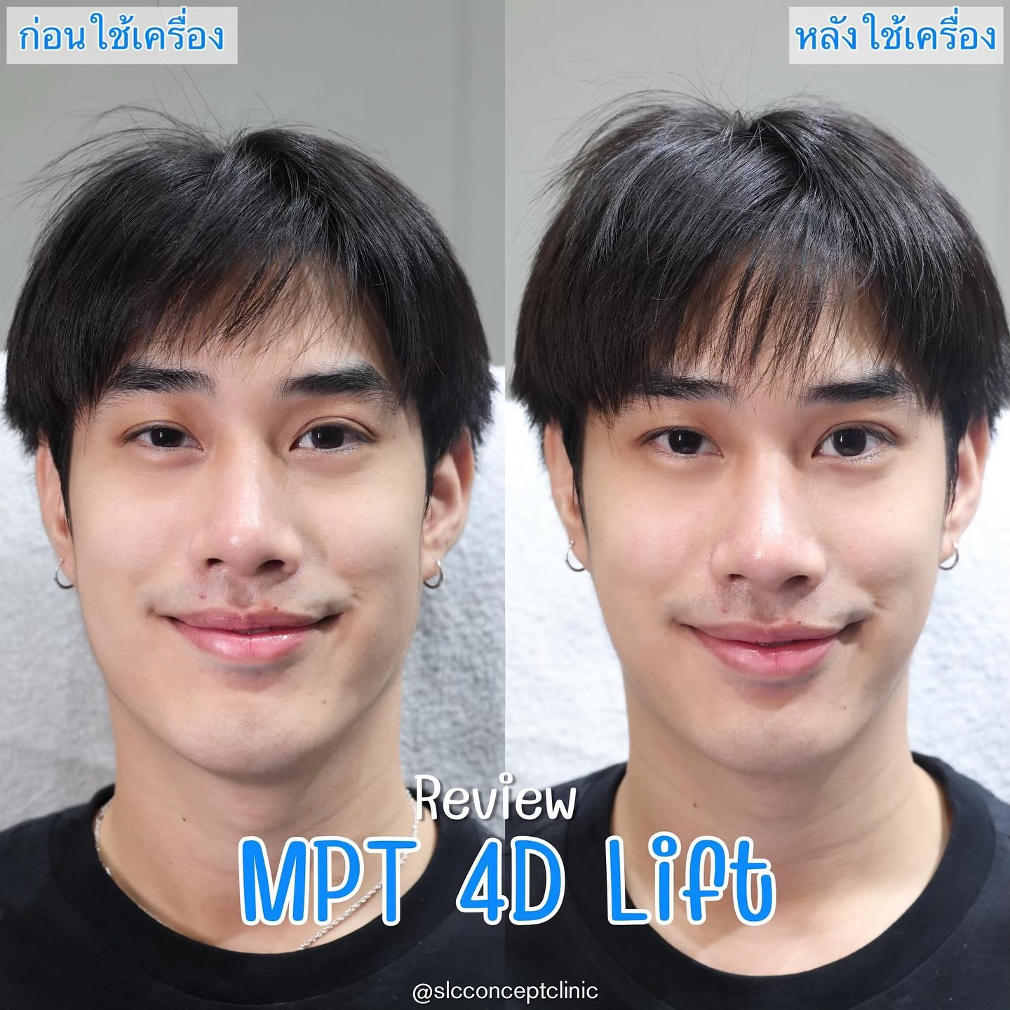 MPT 4D Lift