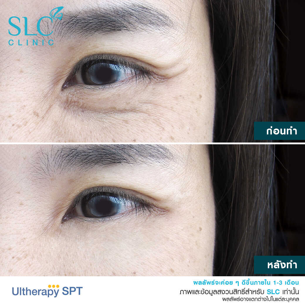 Ultherapy แก้หนังตาตก ยกคิ้ว