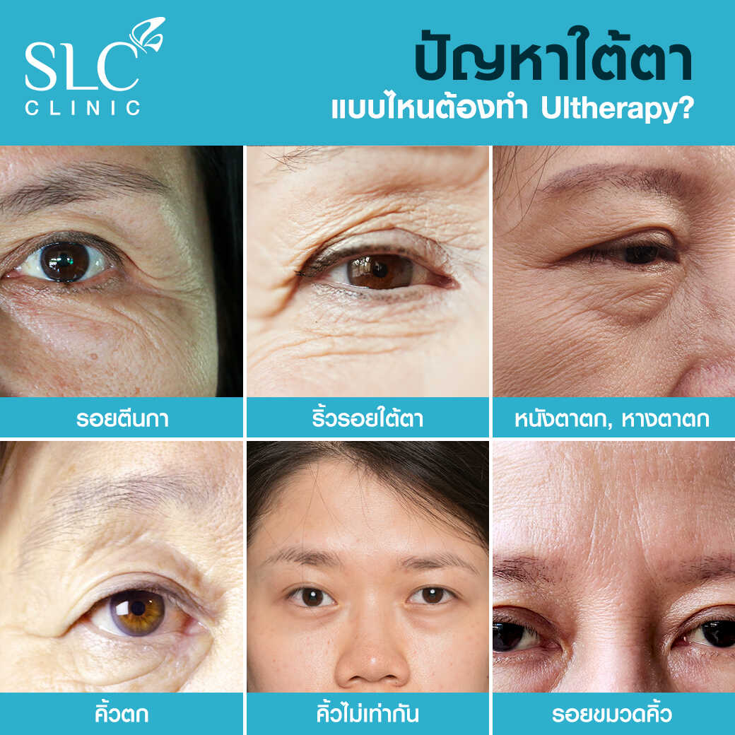 Ultherapy แก้หนังตาตก ยกคิ้ว