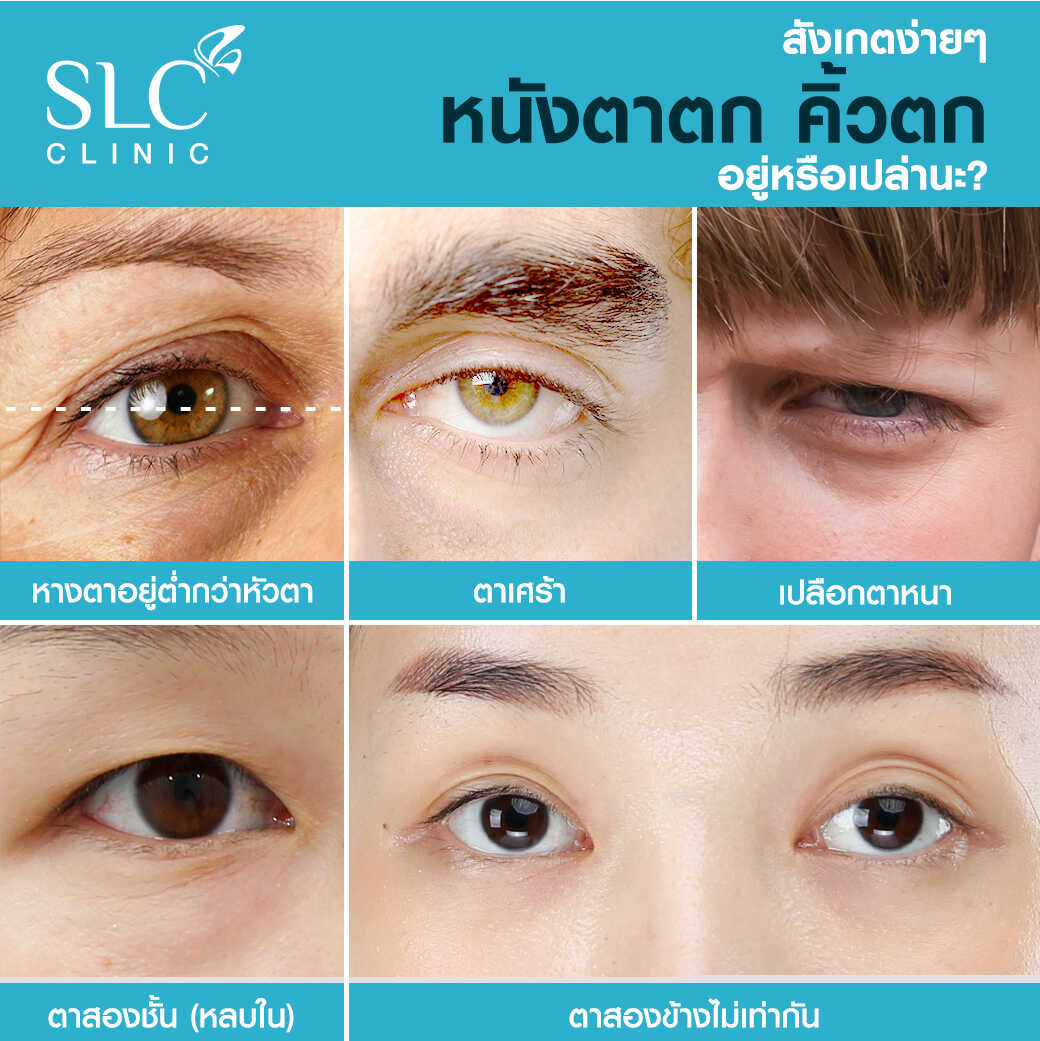 Ultherapy แก้หนังตาตก ยกคิ้ว