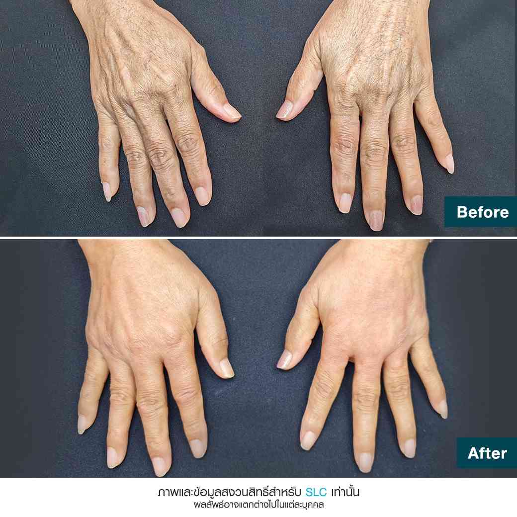 รีวิวฟิลเลอร์มือแก้มือเหี่ยว-ฟิลเลอร์มือ