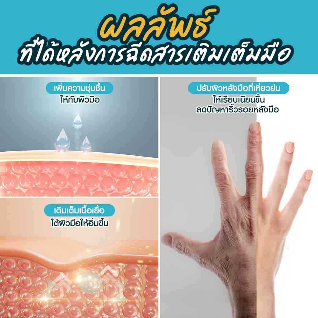 ผลลัพธ์หลังฉีดสารเติมเต็มมือ-ฟิลเลอร์มือแก้มือเหี่ยว-ฟิลเลอร์มือ