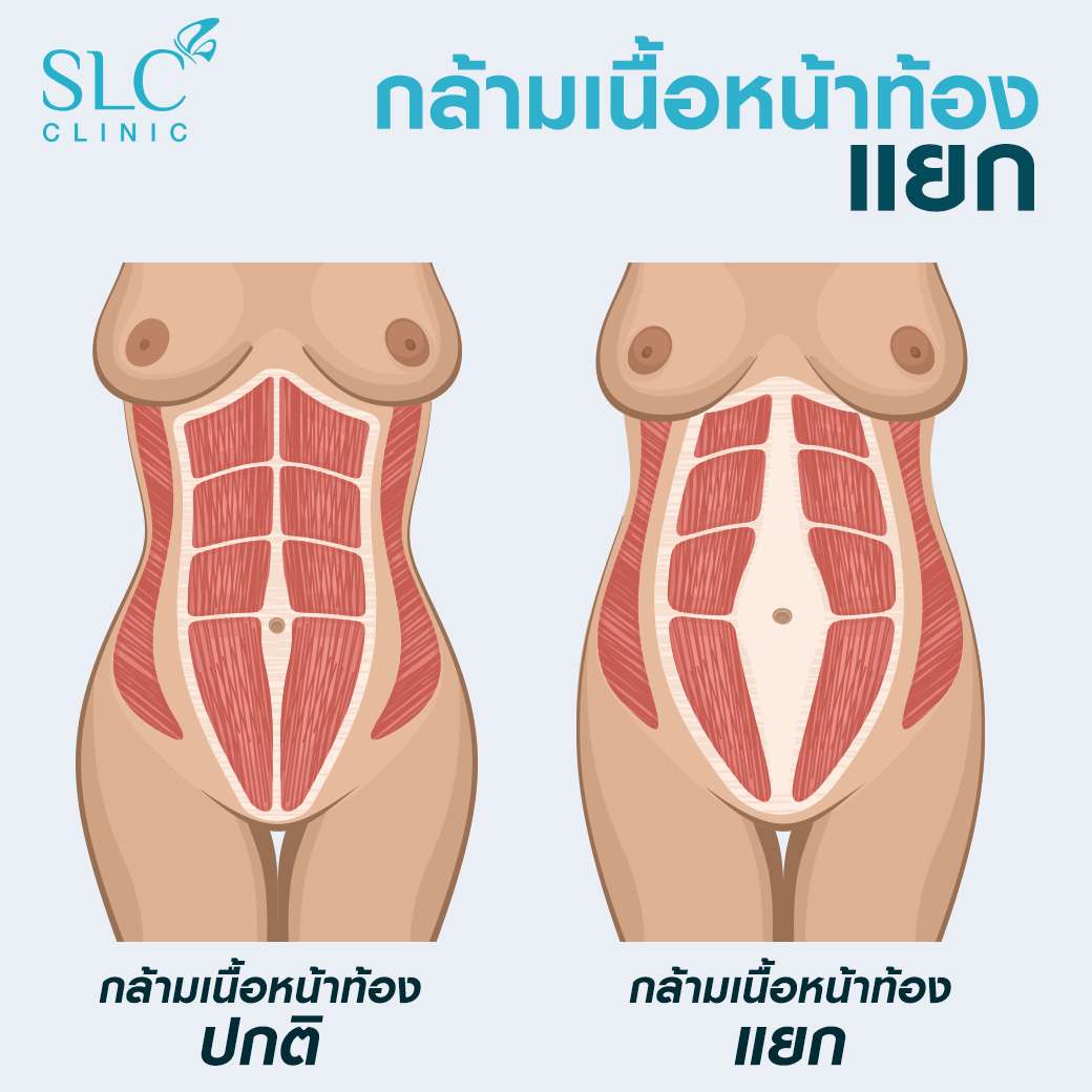 tesla_กล้ามเนื้อหน้าท้องแยก_คุณแม่หลังคลอด
