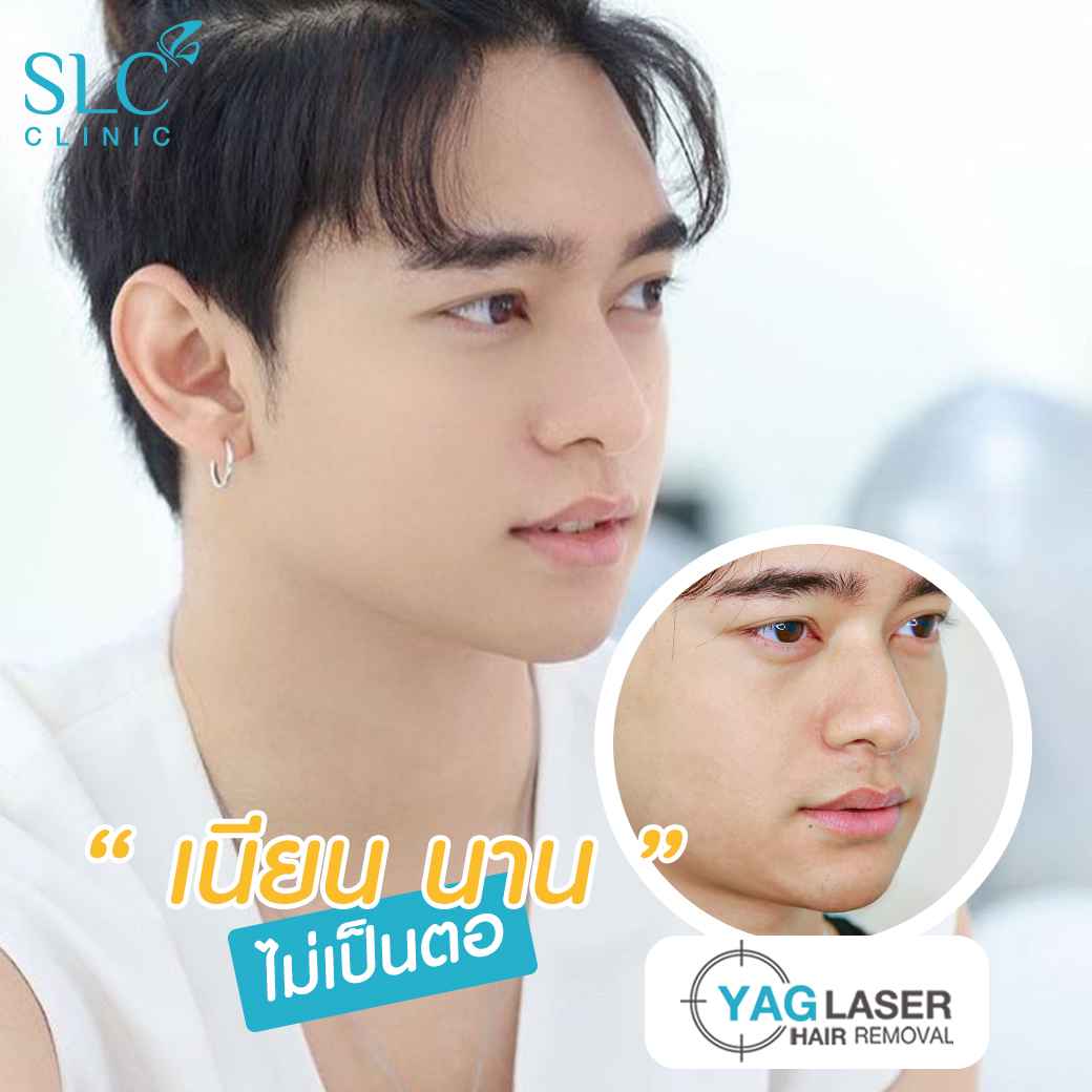  มูสกำจัดขน, เลเซอร์ขน, slc เลเซอร์ขน, เลเซอร์ขน yag, เลเซอร์ขน slc, slc clinic เลเซอร์ขน, กำจัดขน, gentle yag laser