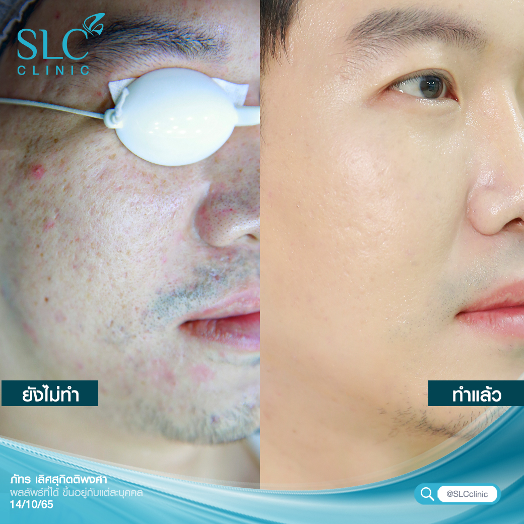 Pico Plus Laser, เลเซอร์หน้าใส