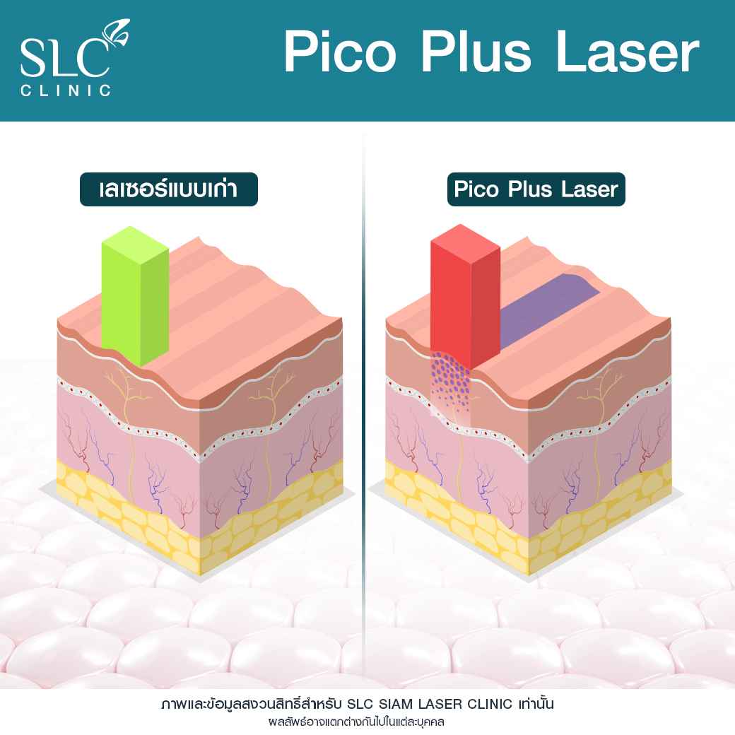 Pico Plus Laser, เลเซอร์หน้าใส