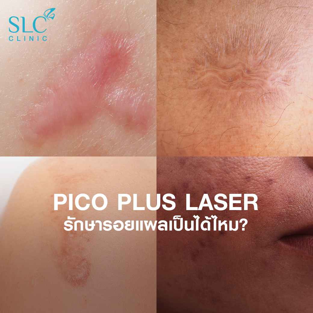 Pico Plus Laser, เลเซอร์หน้าใส