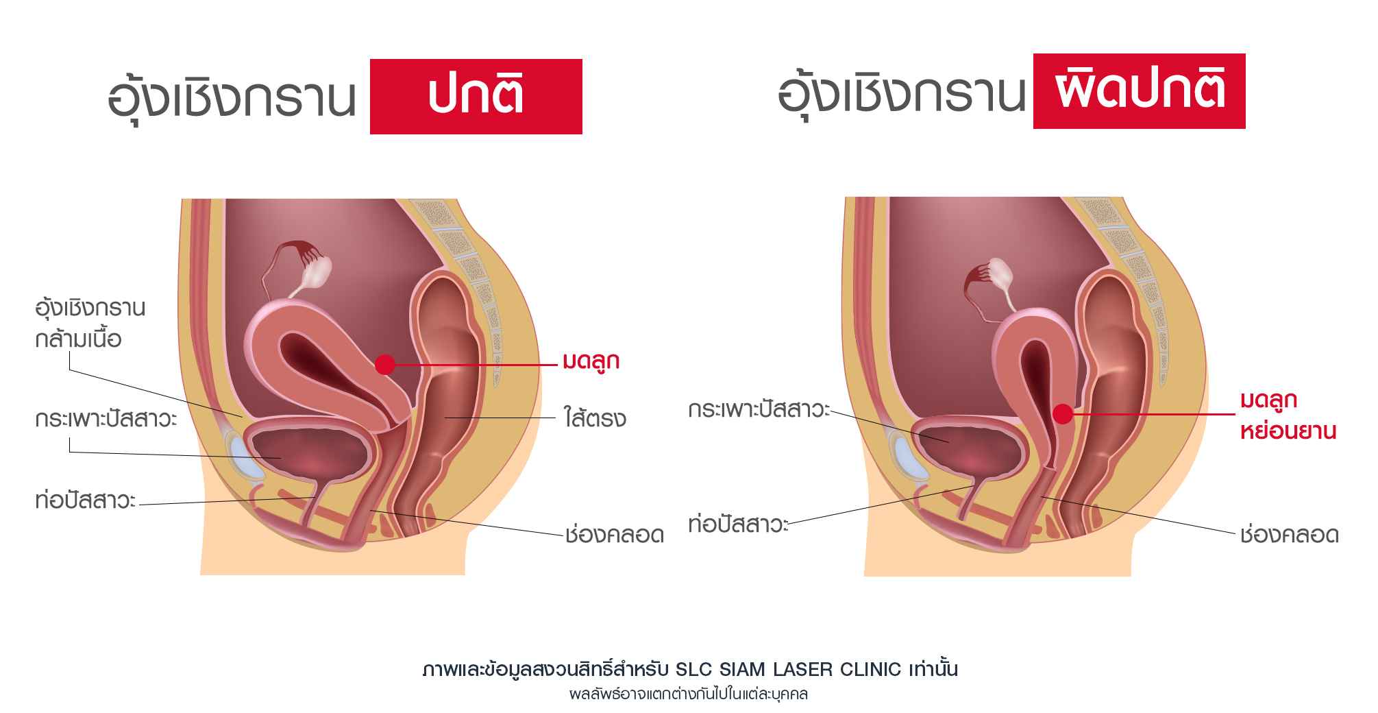 Tesla Former_กระชับช่องคลอด_เรื่อง18+