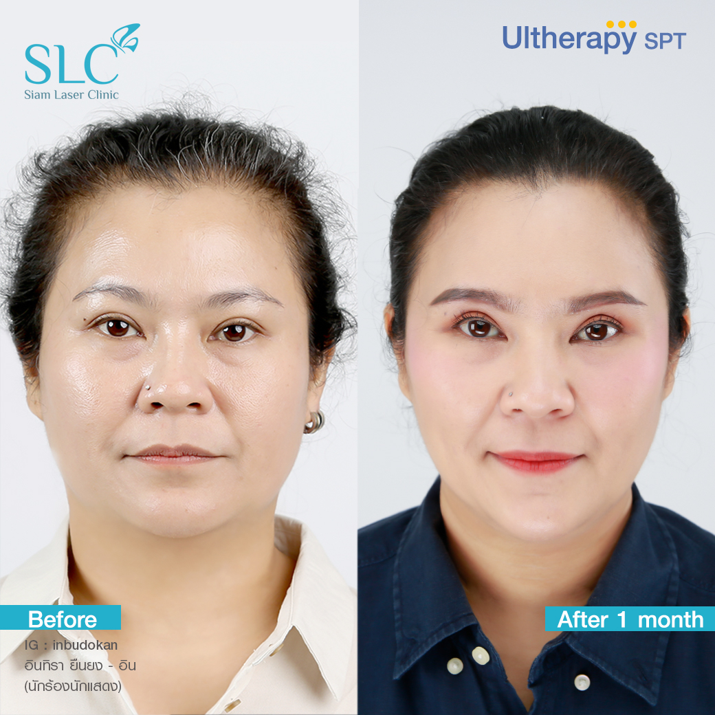 ยกกระชับ Thermage Ultherapy