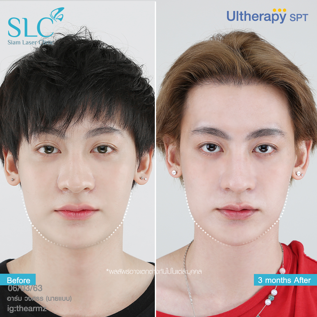 ยกกระชับ Thermage Ultherapy