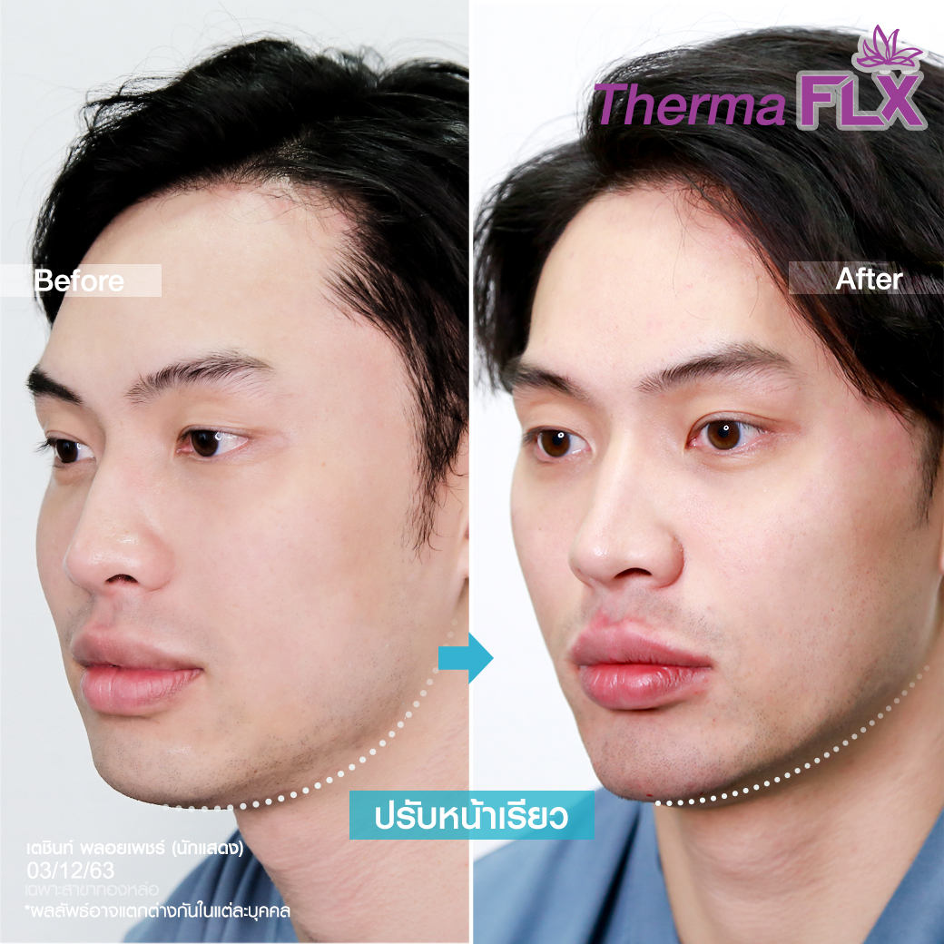 ยกกระชับ Thermage Ultherapy