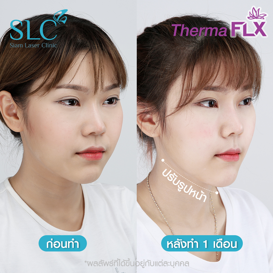 ยกกระชับ Thermage Ultherapy