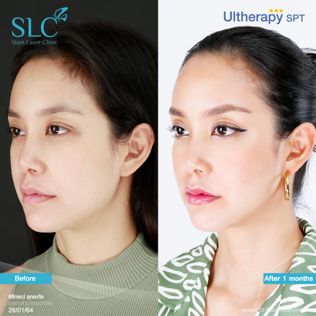 ยกกระชับ Thermage Ultherapy