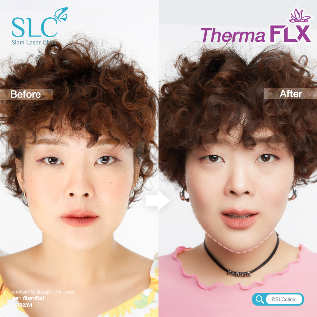 ยกกระชับ Thermage Ultherapy