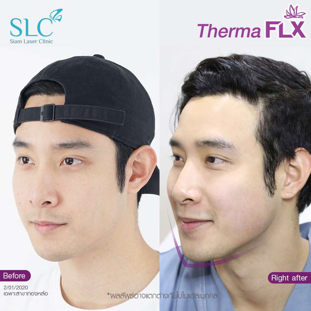 ยกกระชับ Thermage FLX