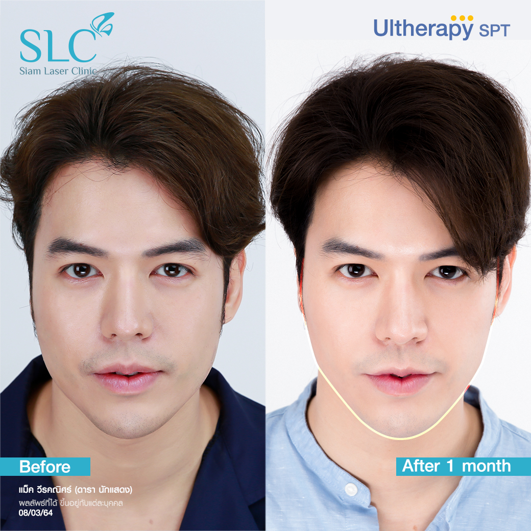 ยกกระชับ Thermage Ultherapy