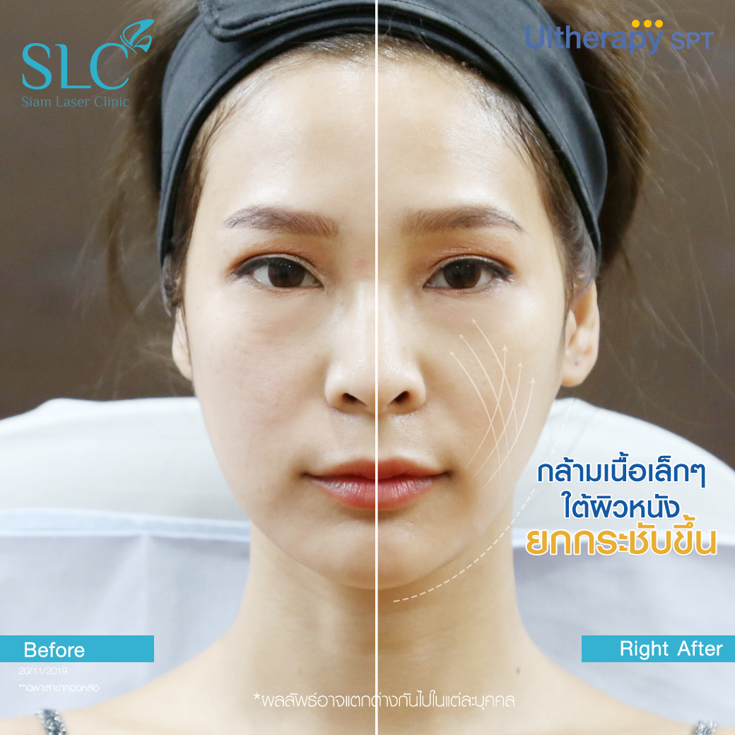 ยกกระชับ Thermage Ultherapy