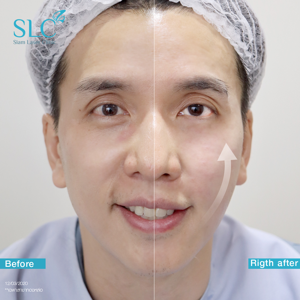 ยกกระชับ Thermage Ultherapy