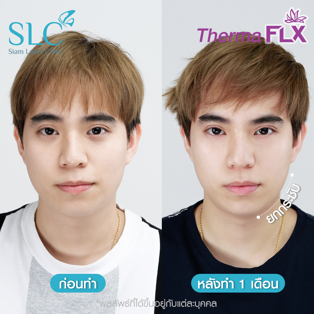 ยกกระชับ Thermage Ultherapy