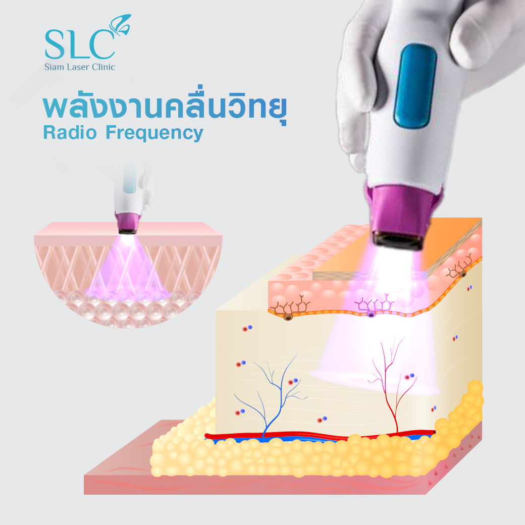 ยกกระชับ Thermage Ultherapy