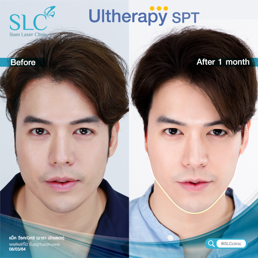 กรอบหน้าชัด , ยกกระชับ Ulthera , Ulthera for men ,ลดเหนียง, ยกกระชับผิวผู้ชาย, Jawline 