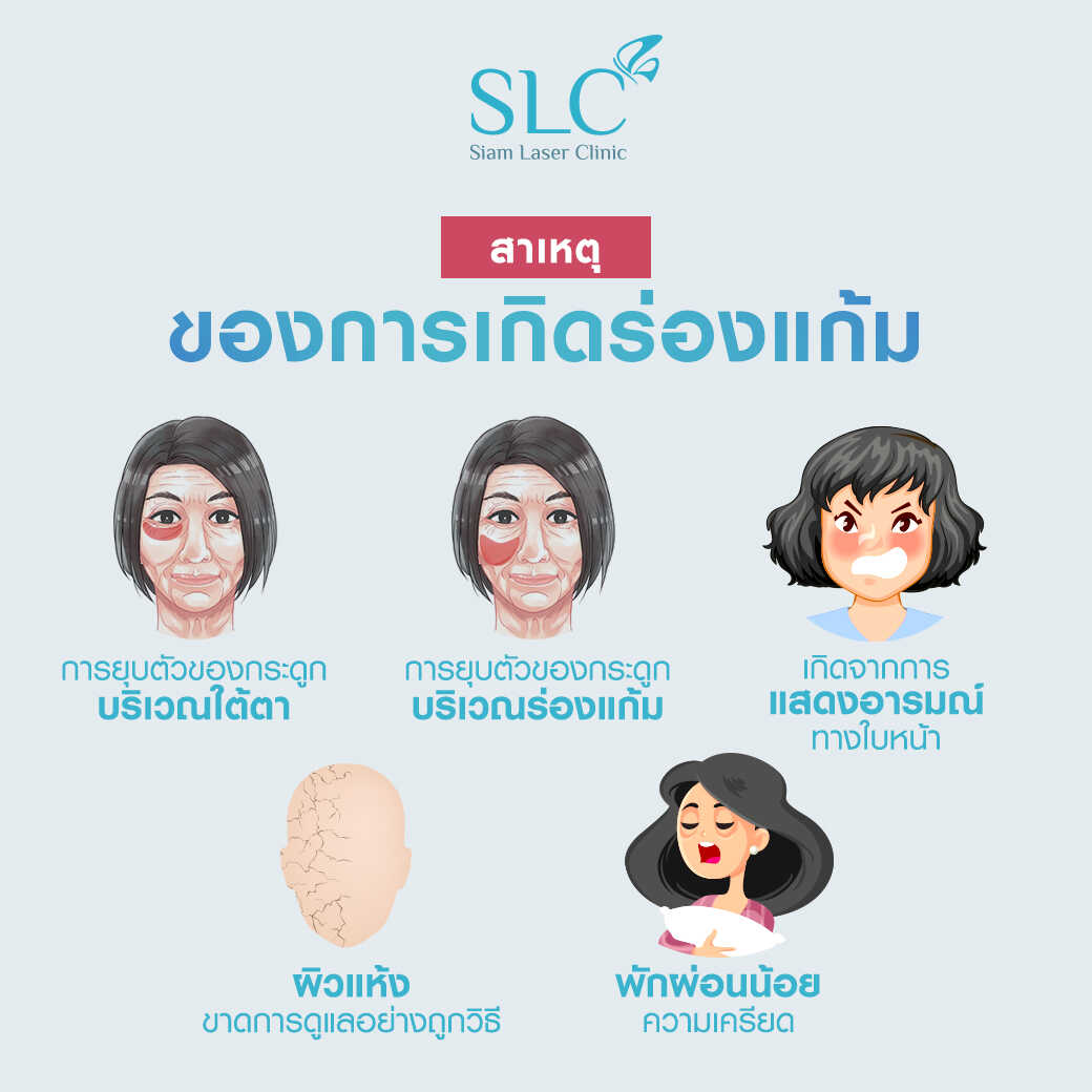 สารเติมเต็ม_ร่องแก้ม_Cheek_Filler