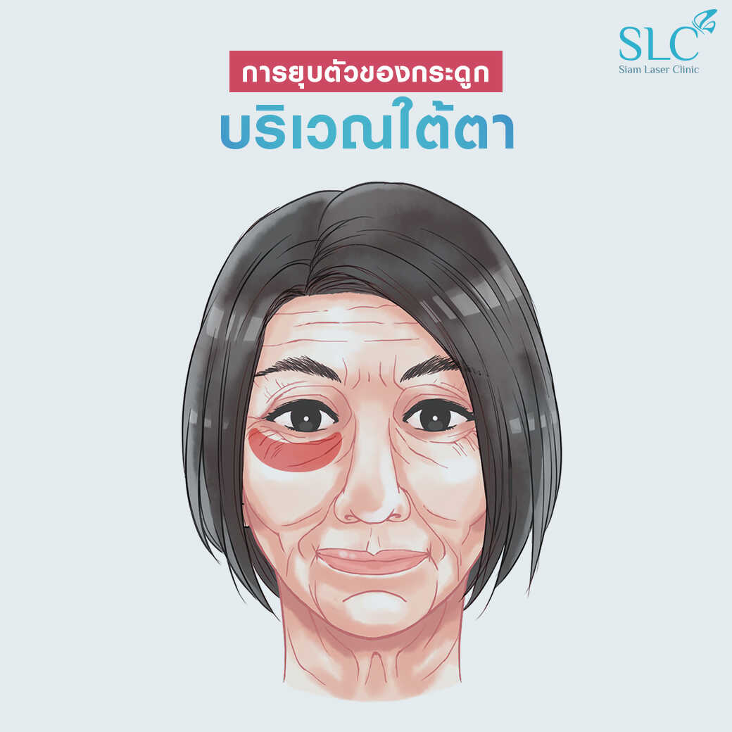 สารเติมเต็ม_ร่องแก้ม_Cheek_Filler