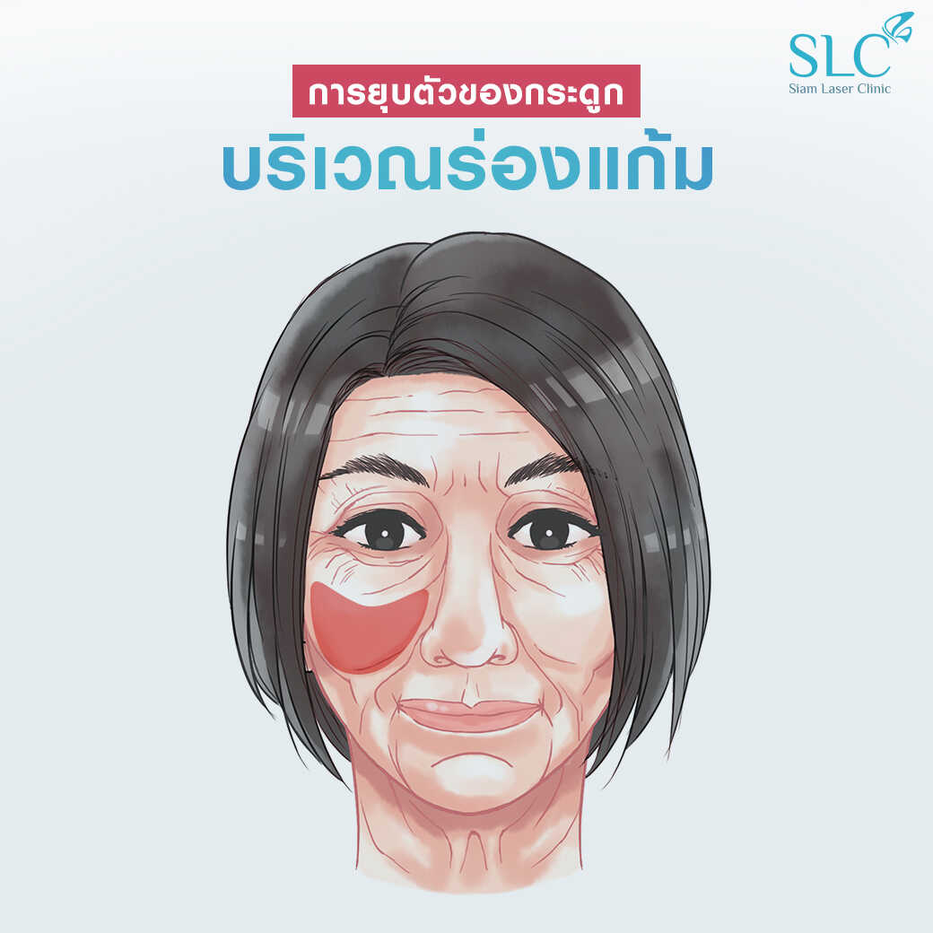 สารเติมเต็ม_ร่องแก้ม_Cheek_Filler