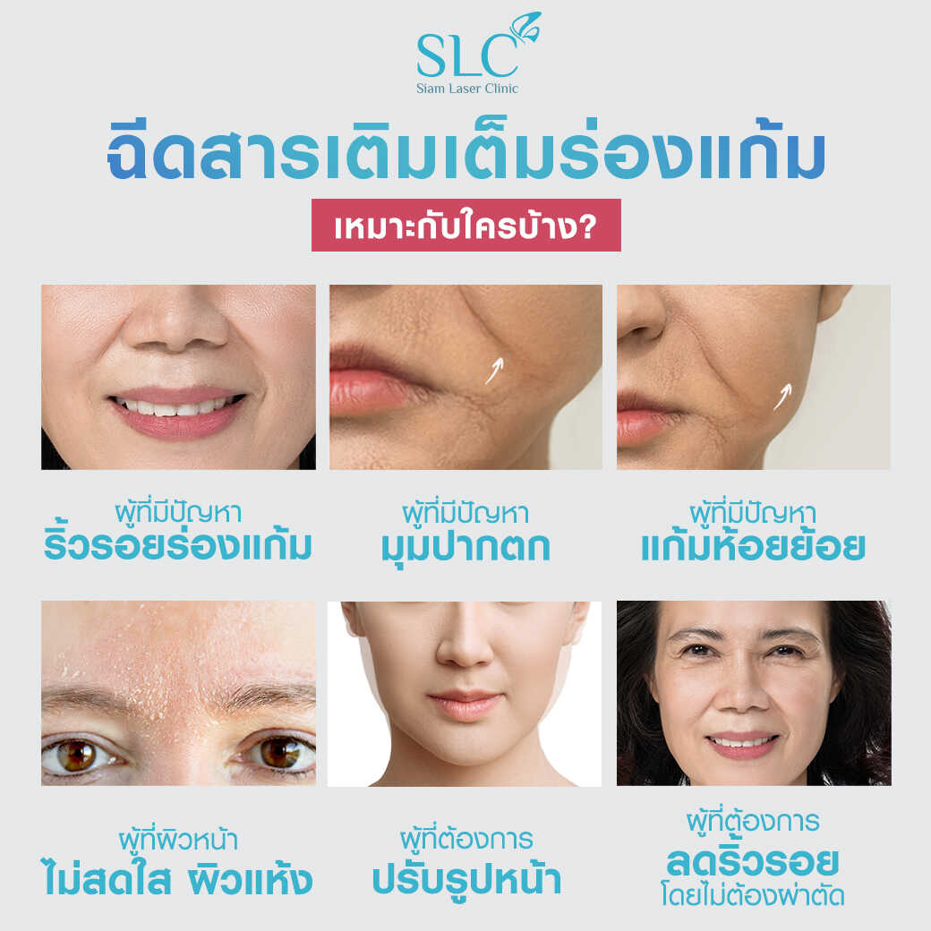 สารเติมเต็ม_ร่องแก้ม_Cheek_Filler