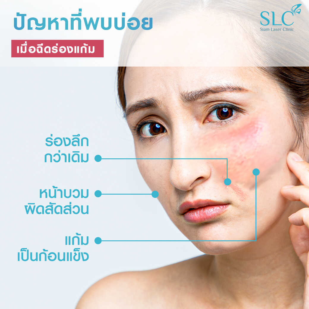 สารเติมเต็ม_ร่องแก้ม_Cheek_Filler