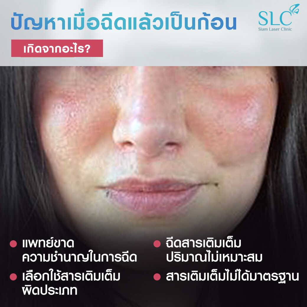 สารเติมเต็ม_ร่องแก้ม_Cheek_Filler