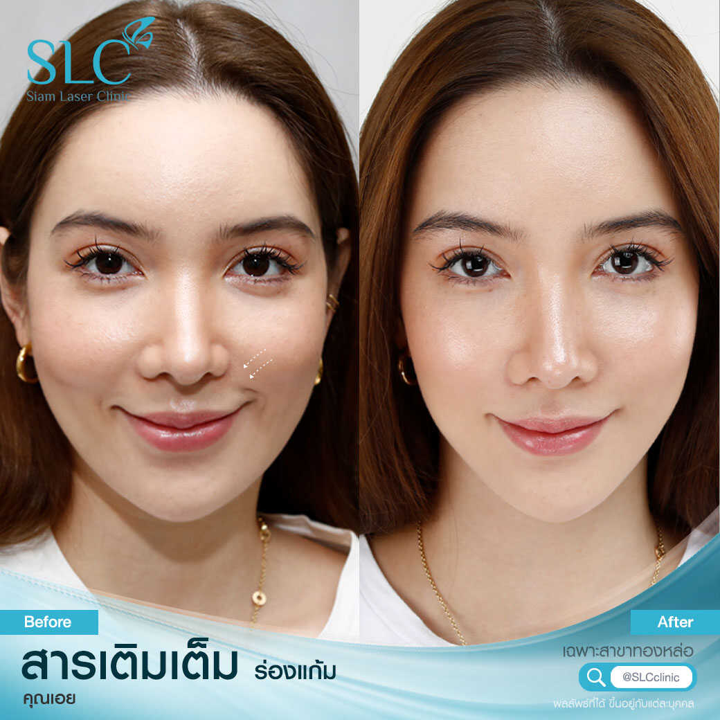 สารเติมเต็ม_ร่องแก้ม_Cheek_Filler