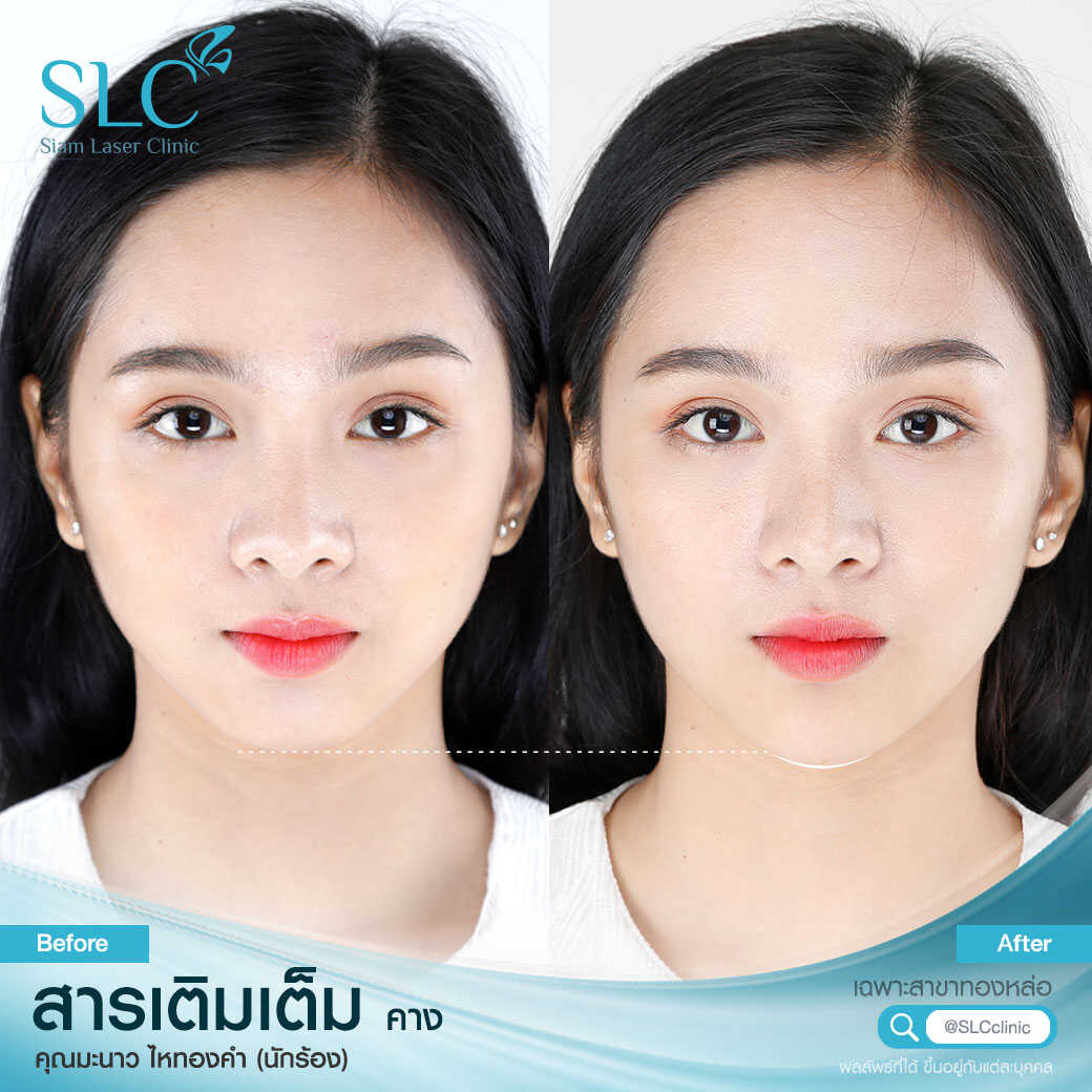 สารเติมเต็ม_ร่องแก้ม_Cheek_Filler