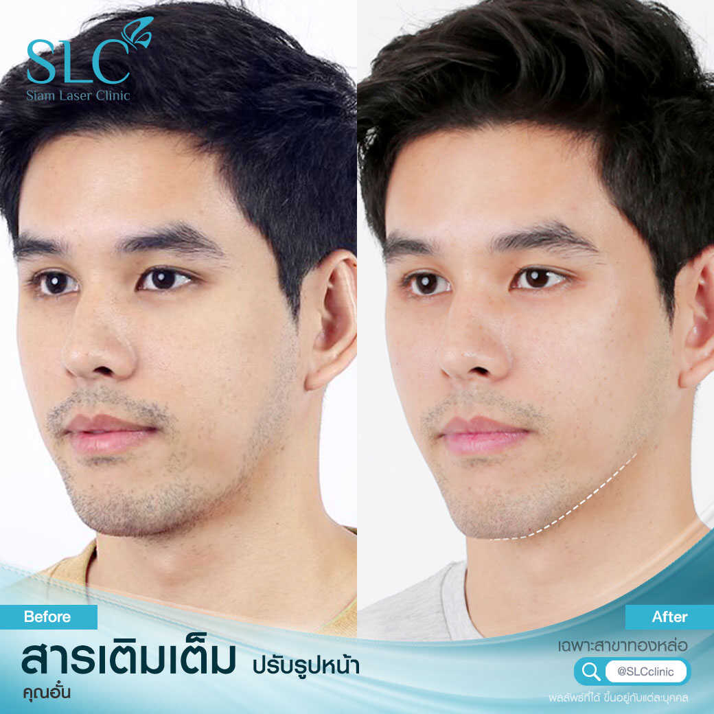 สารเติมเต็ม_ร่องแก้ม_Cheek_Filler