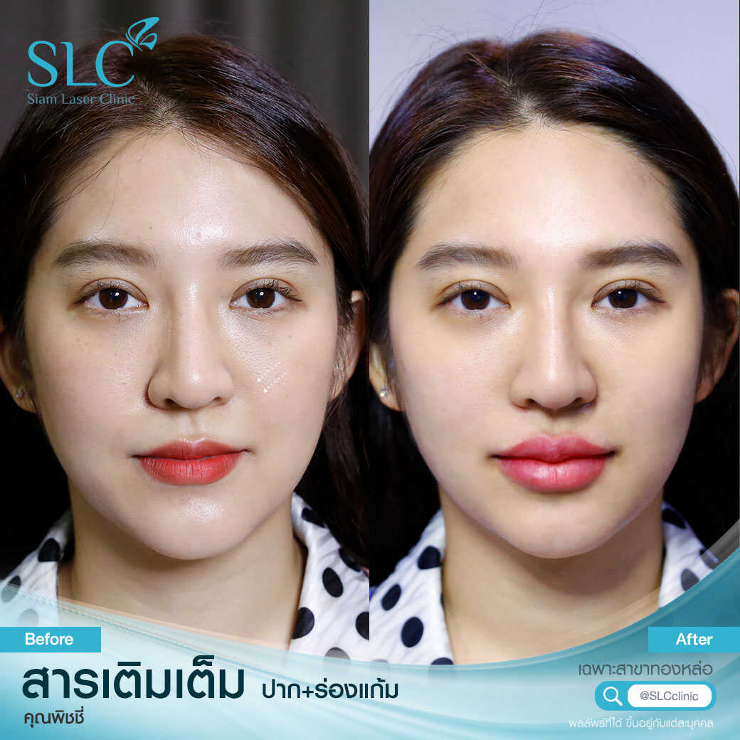 สารเติมเต็ม_ร่องแก้ม_Cheek_Filler