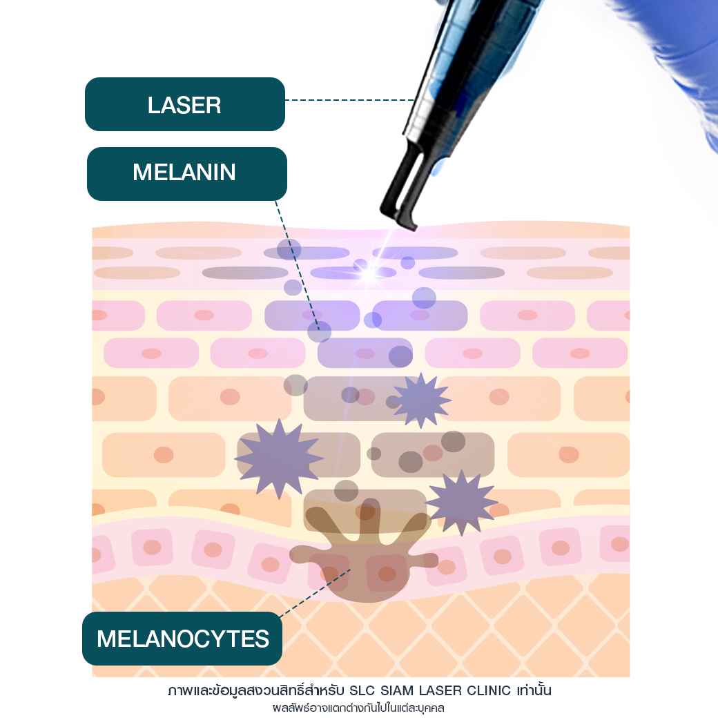 รักษาฝ้า_เลเซอร์ฝ้า_pico laser_ประเภทของฝ้า