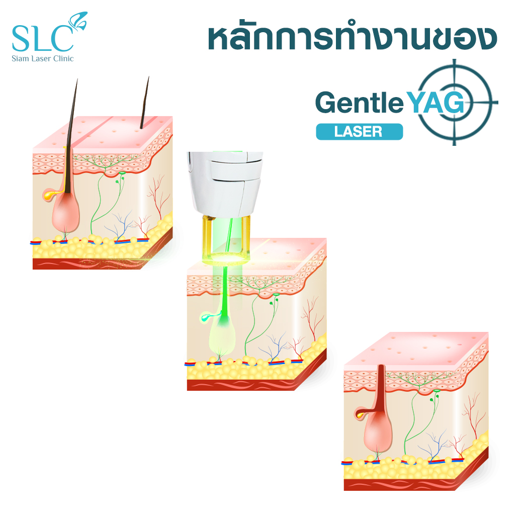 Hair Laser Removal_เลเซอร์ขน กำจัดขน