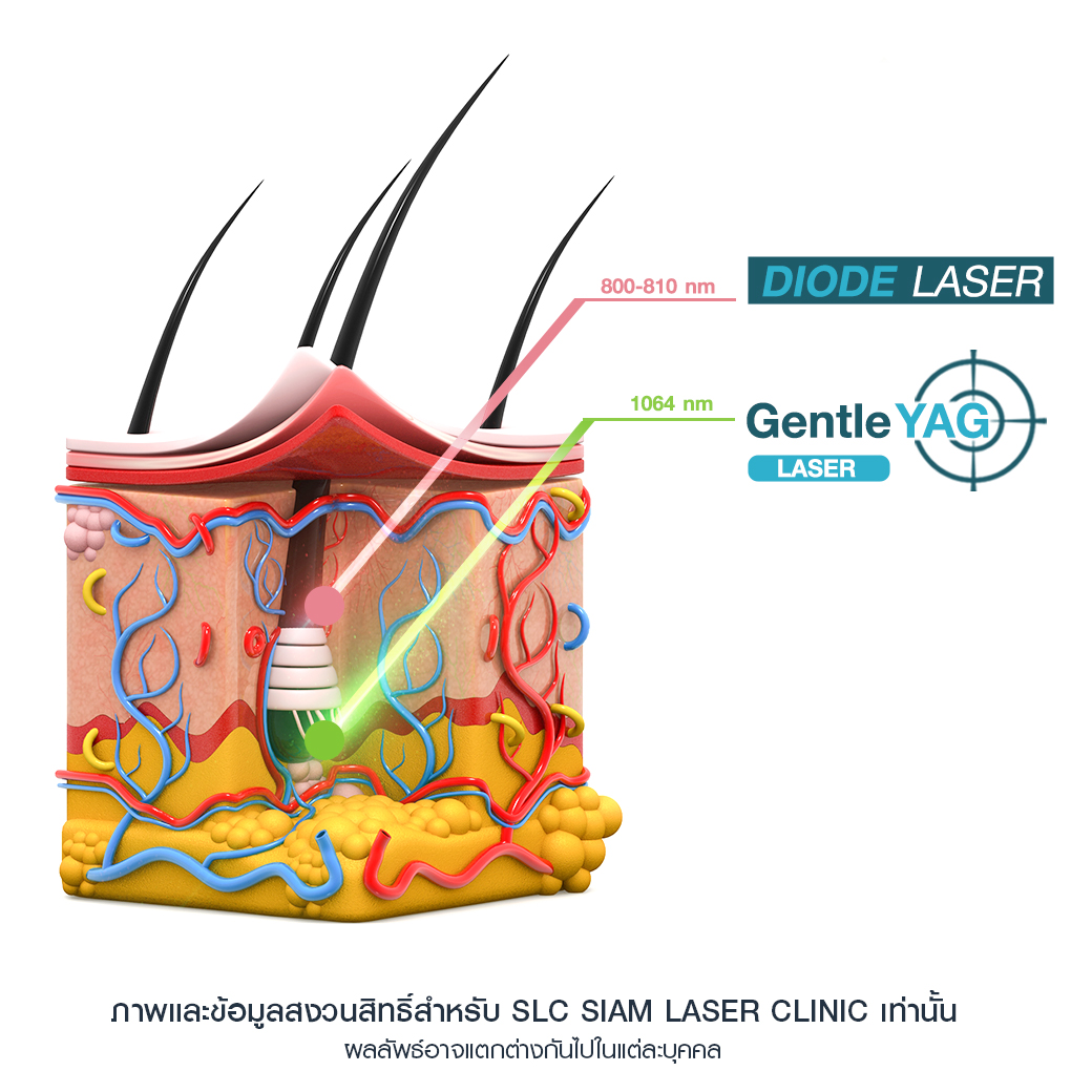 เลเซอร์กำจัดขน_Laser Hair Removal