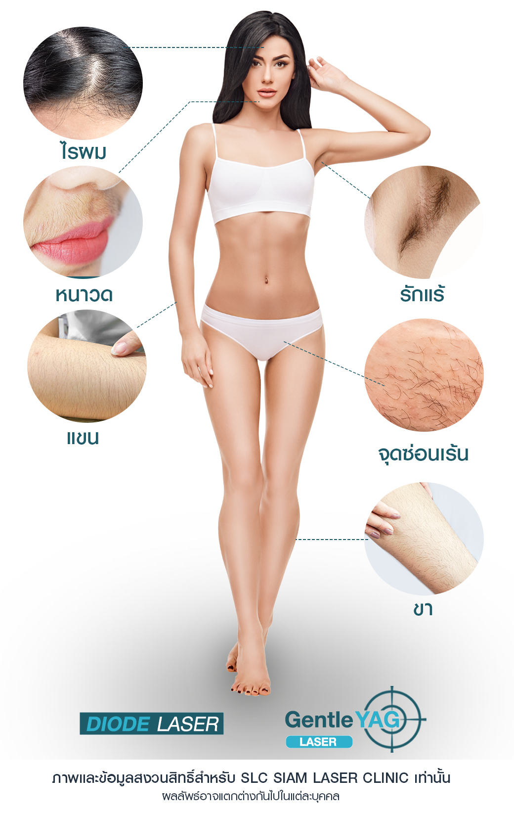 Hair Laser Removal_เลเซอร์ขน กำจัดขน