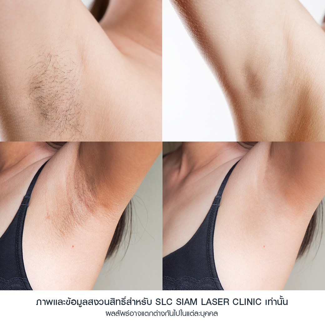 Hair Laser Removal_เลเซอร์ขน กำจัดขน