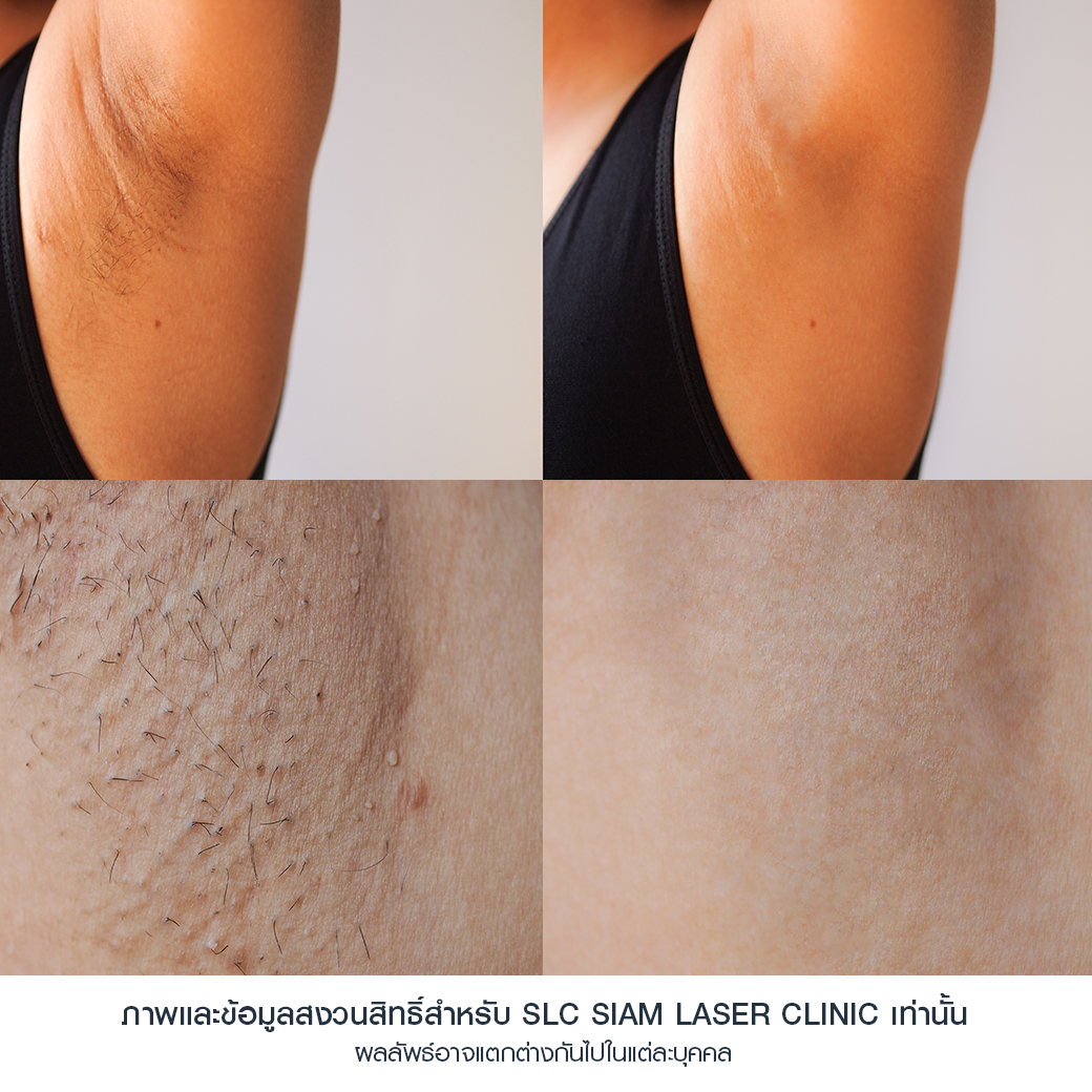 Hair Laser Removal_เลเซอร์ขน กำจัดขน