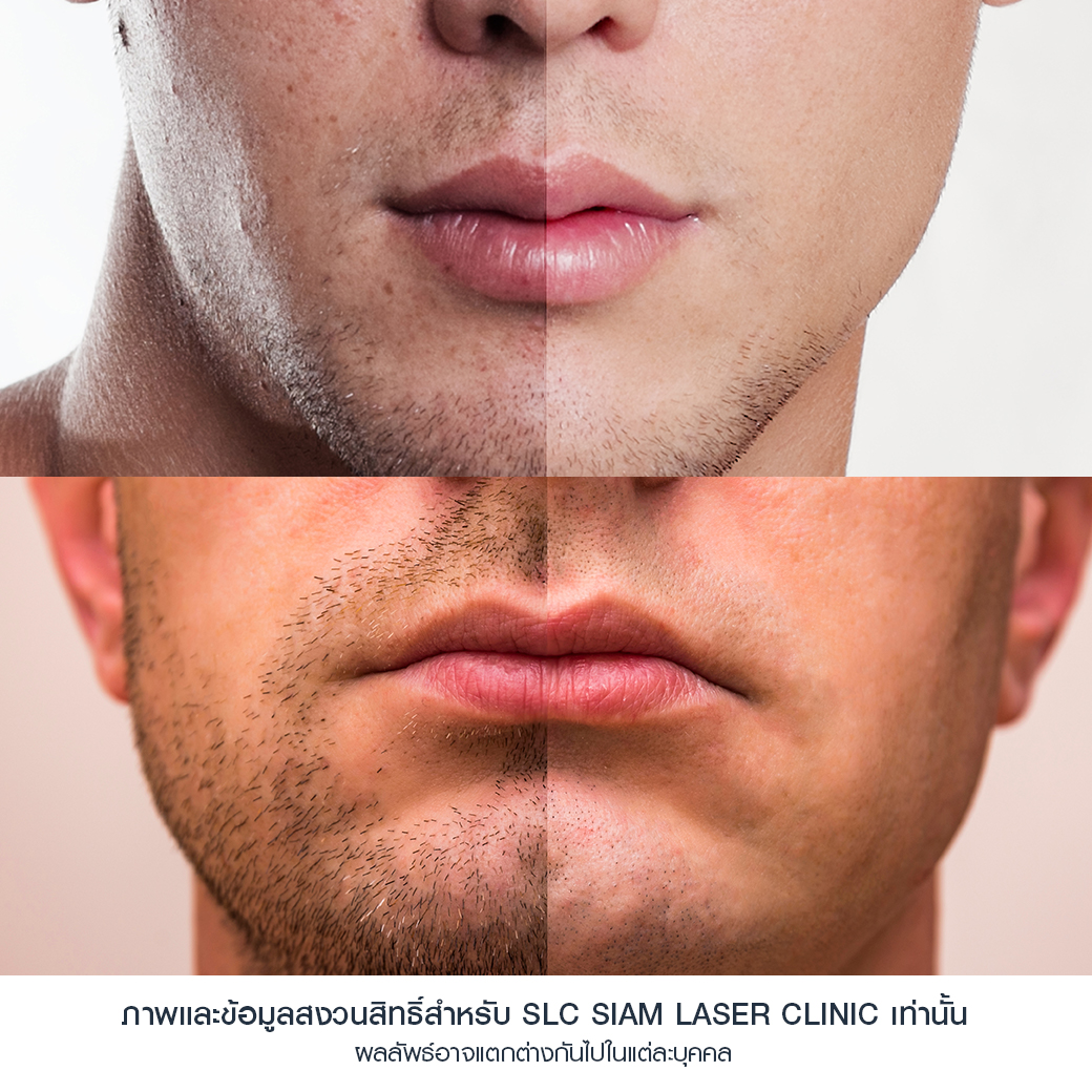 Hair Laser Removal_เลเซอร์ขน กำจัดขน