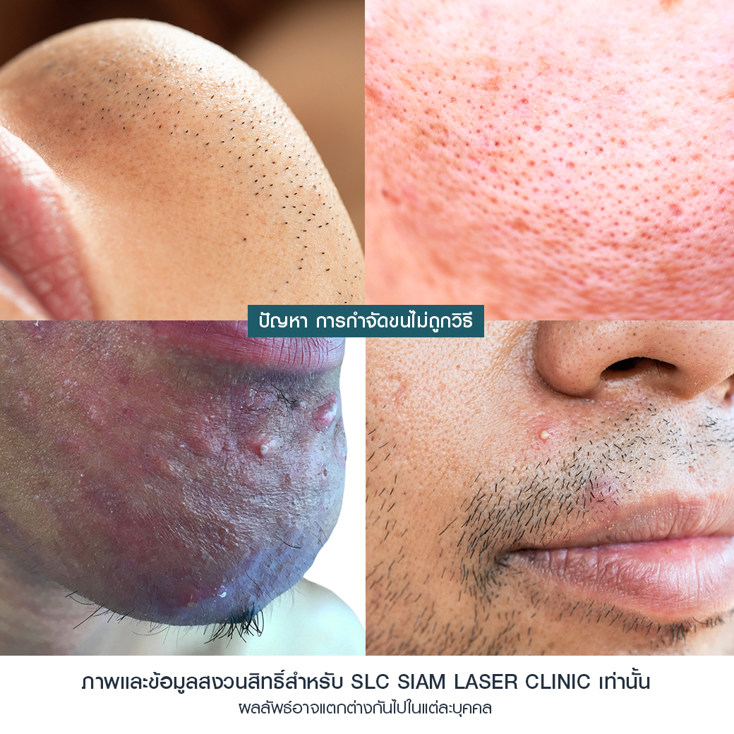 Hair Laser Removal_เลเซอร์ขน กำจัดขน