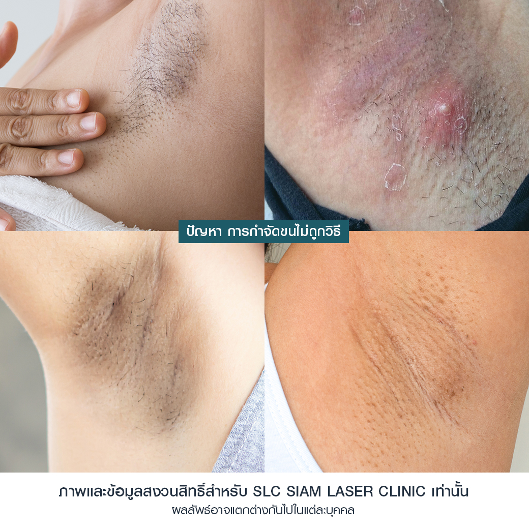 Hair Laser Removal_เลเซอร์ขน กำจัดขน