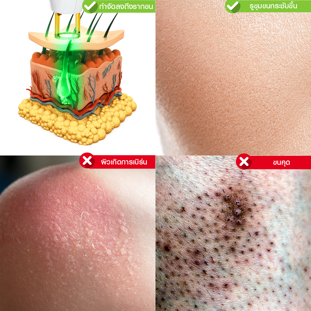 Hair Laser Removal_เลเซอร์ขน กำจัดขน