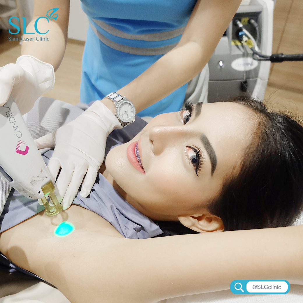 เลเซอร์กำจัดขน_Laser Hair Removal