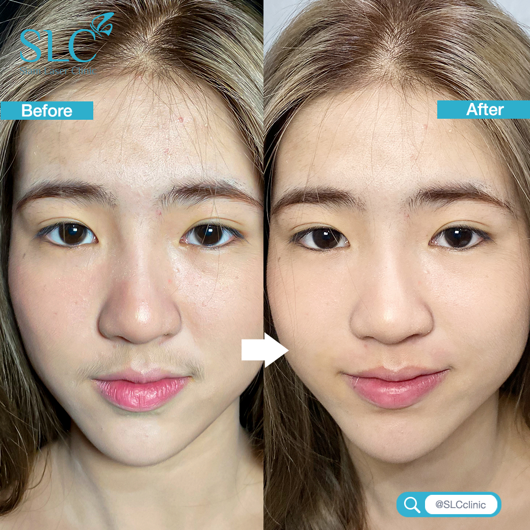 Laser Hair Removal_เลเซอร์ กำจัดขน