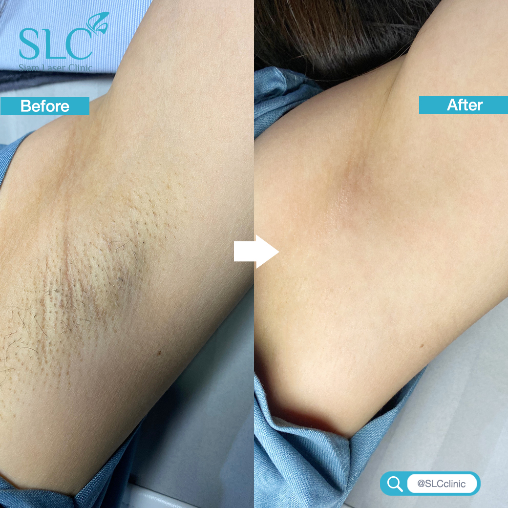 Hair Laser Removal_เลเซอร์ขน กำจัดขน