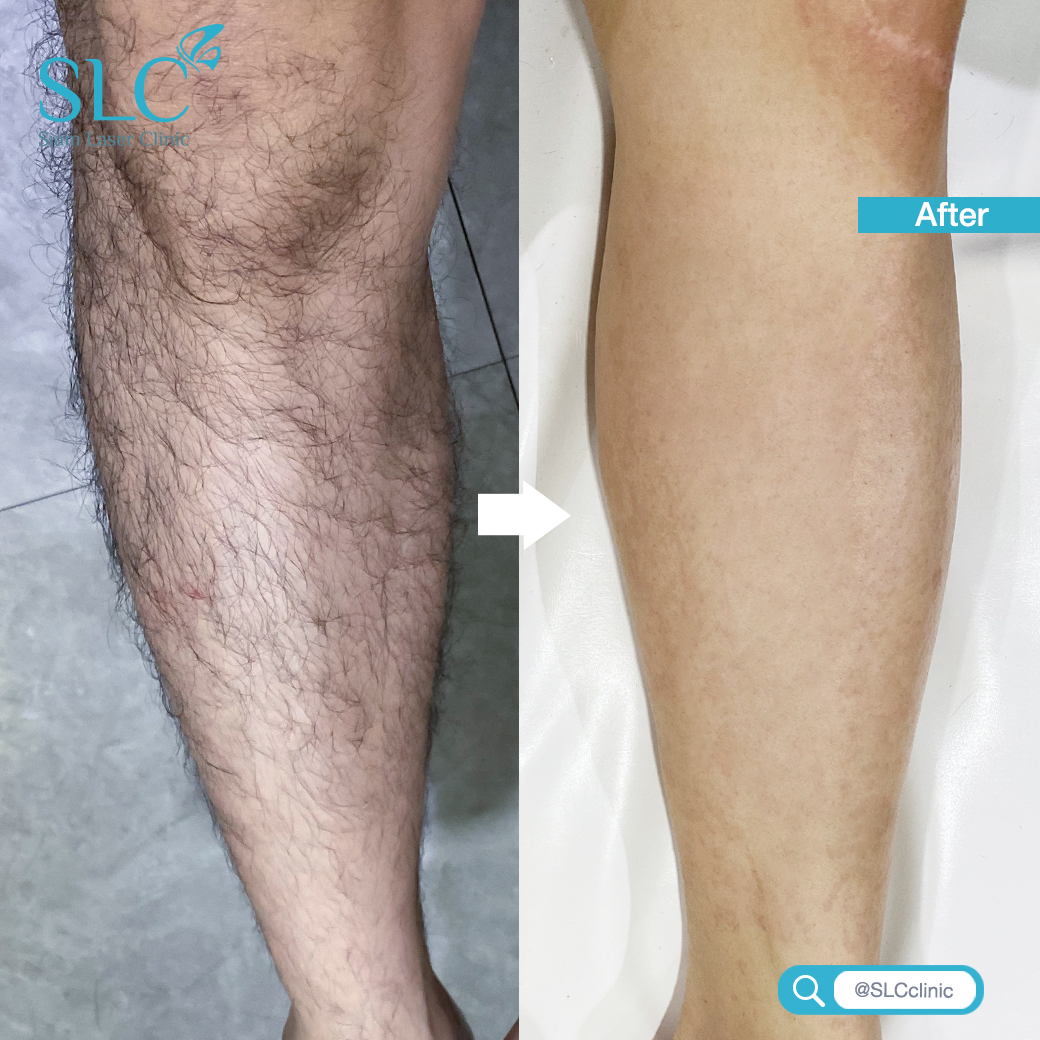 Hair Laser Removal_เลเซอร์ขน กำจัดขน