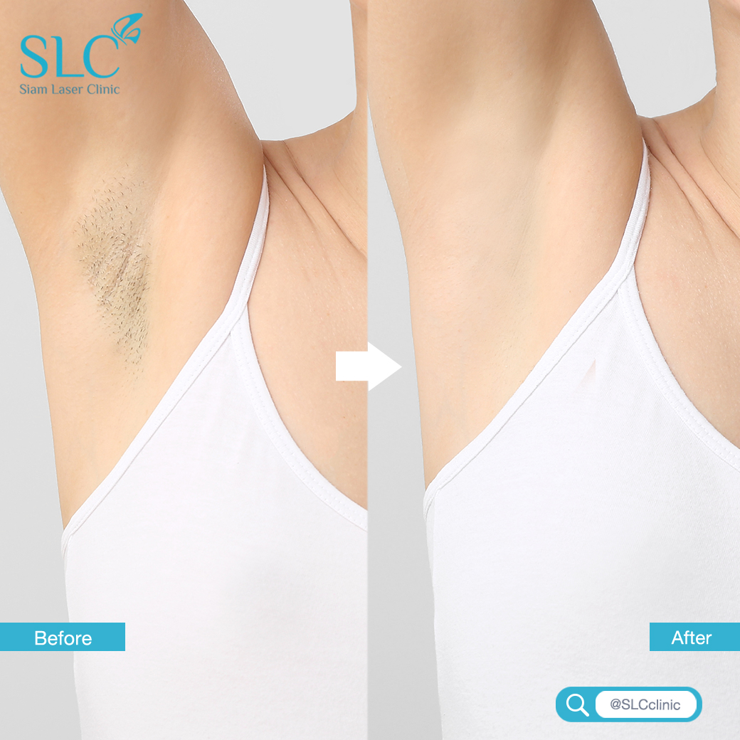 Hair Laser Removal_เลเซอร์ขน กำจัดขน